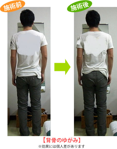 背骨のゆがみ
